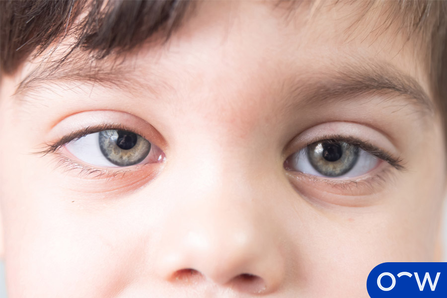 Lazy Eye (Amblyopia) Causes, Symptoms, Diagnosis, and Treatment