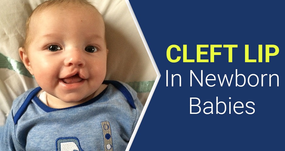 Everything you need to know about cleft lip in babies