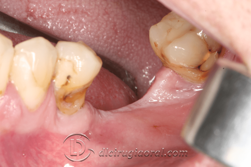 Vestibuloplasty Improving soft tissues DL Oral Surgery
