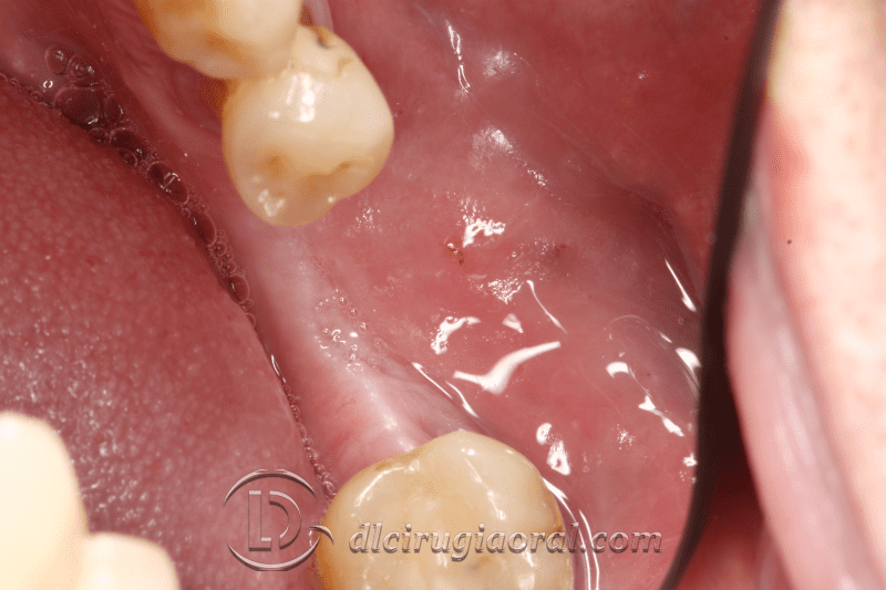 Vestibuloplasty Improving soft tissues DL Oral Surgery