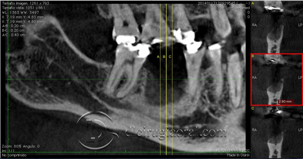 Kazanjian vestibuloplasty archivos DL Oral Surgery