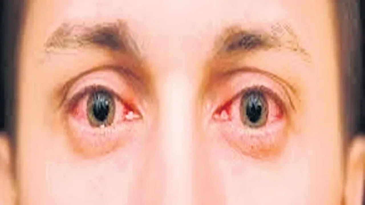 Conjunctivitis ఆకస్మాత్తుగా మారిన వాతావరణం.. కళ్లల్లో ఏంటి కలకలం