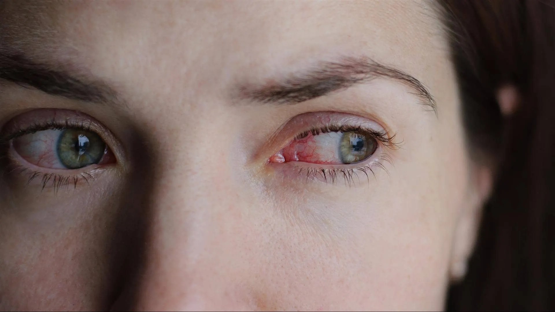 Red, Itchy Eyes Coronavirus or Allergies? DMEI Dean McGee Eye