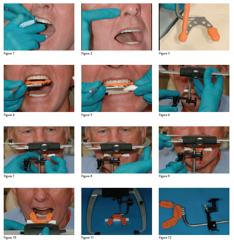 Utilizing an Accurate Bite Registration for a Facebow Transfer DMG