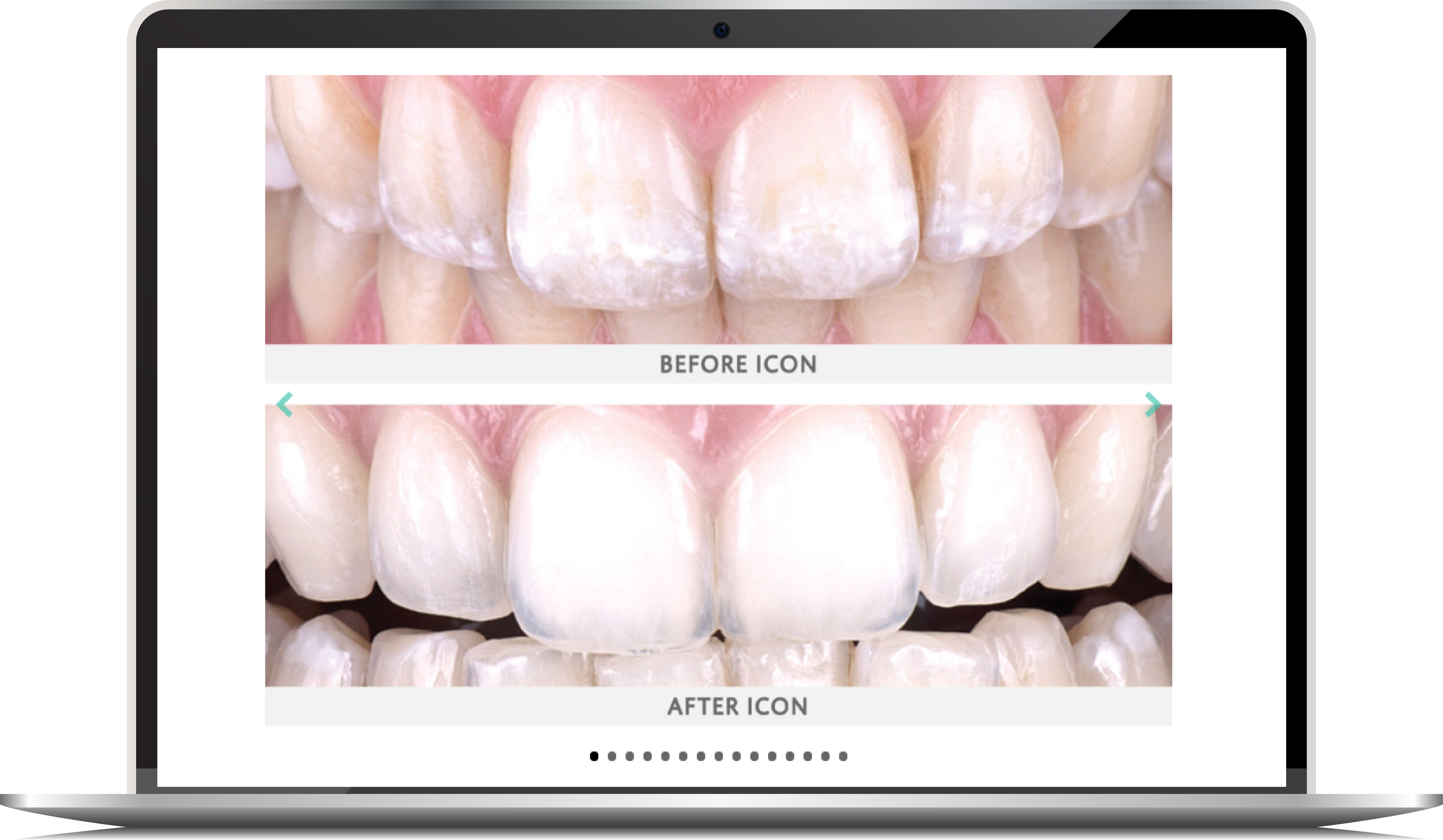 ICON Treatment Mild to Moderate Fluorosis DMG America