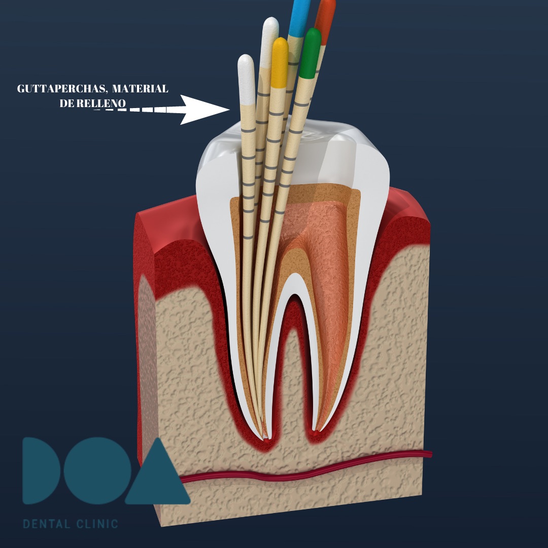 ¿QUÉ ES UNA ENDODONCIA? DOA. Dental Clinic