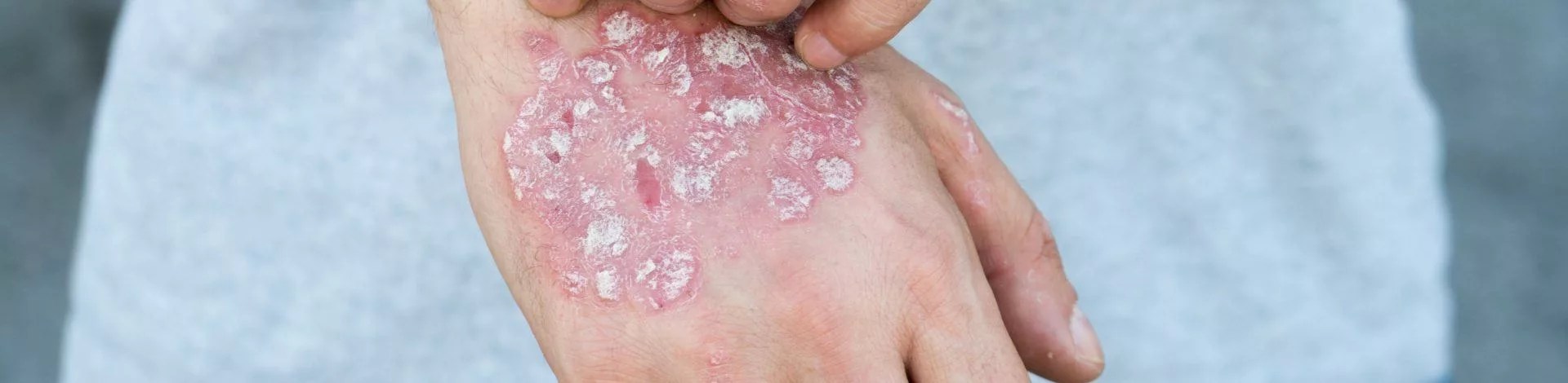 Svamp i huden Video med symptomer, behandling og informationer