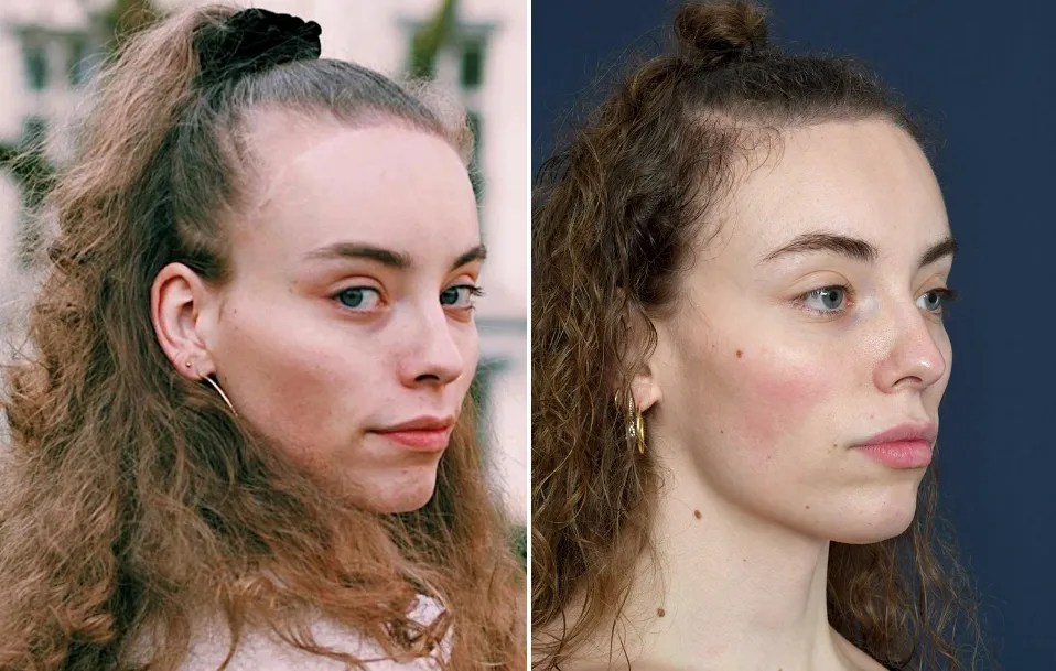 Everything About Hair Implants For Women You Need To Know Hair System