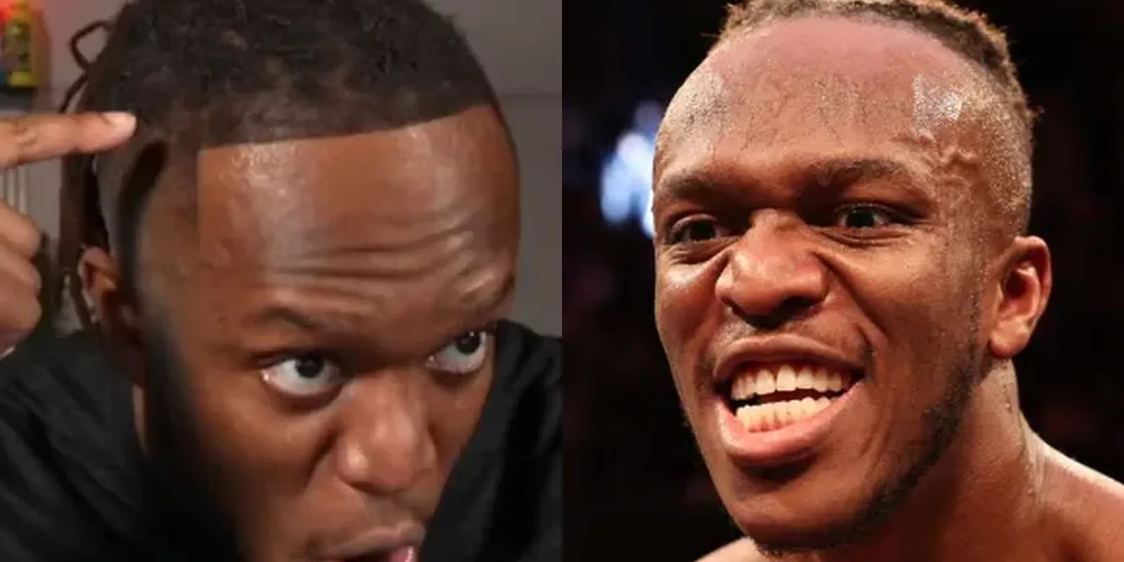 Why is KSI's Hairline Receding and How to Regrow? Hair System