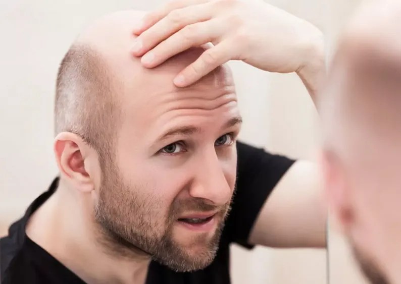 All Baldness Cure and Treatment (2023 Update) Hair System