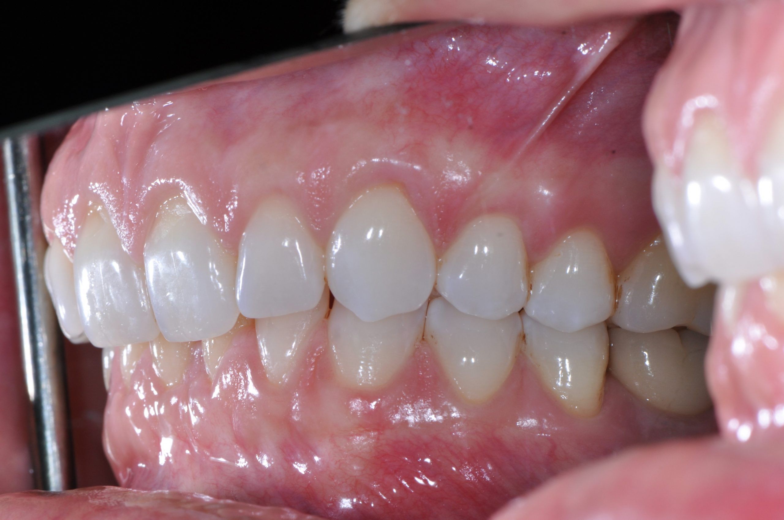 Gingival (Gum) Grafting Dental Implants & Periodontics of CT