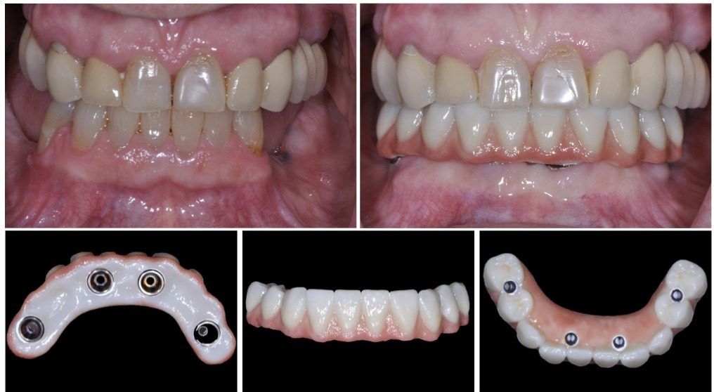Full Arch Options “All on Four” Dental Implants & Periodontics of CT