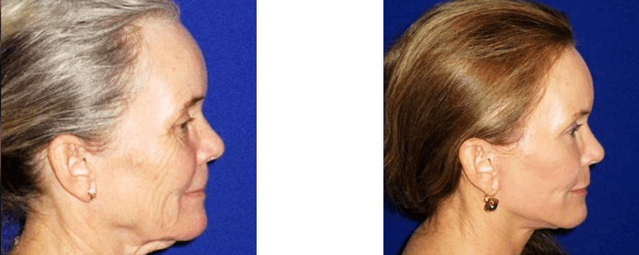 Face lift and Laser Resurfacing Before and After