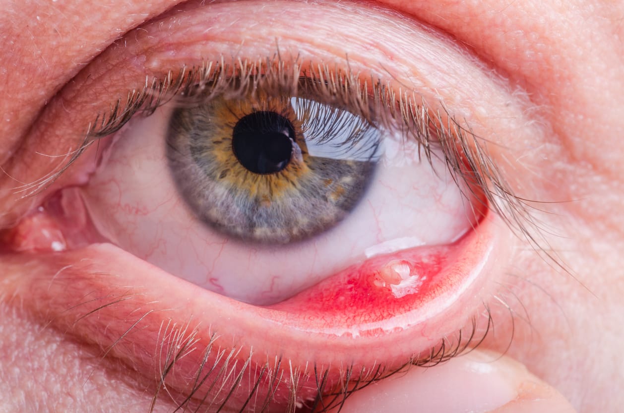 Chalazion causes, symptômes et traitements