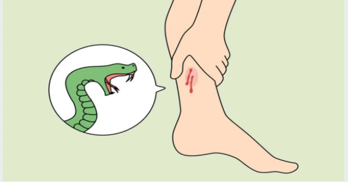 Essential Guide to Snake Bite Management - Your Ultimate Health