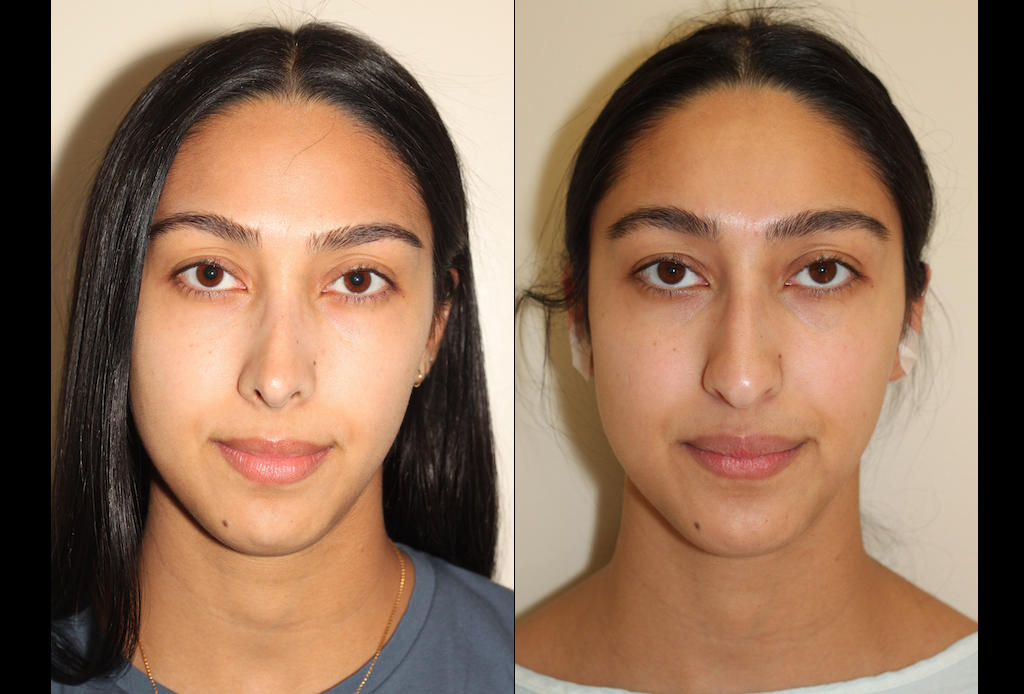 167Rhinoplasty Dr. Denton