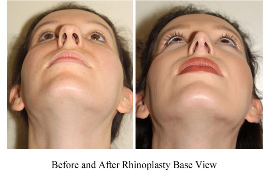 Rhinoplasty Vancouver Nose Reshaping Plastic Surgery