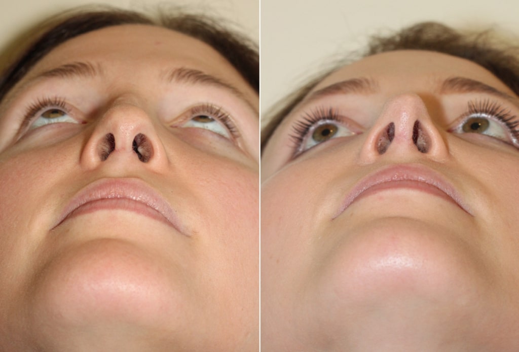 What Does An Open Rhinoplasty Incision Look Like? Seattle