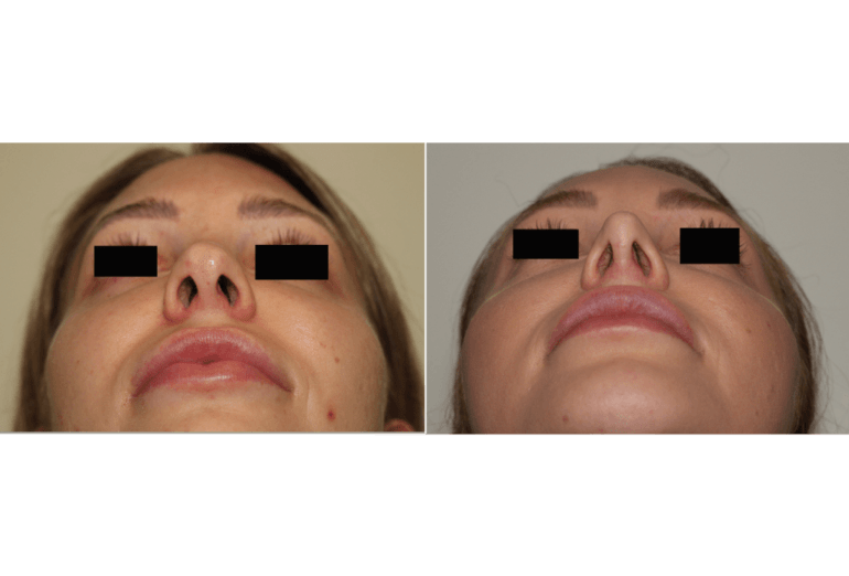 4ChinAugmentationandRhinoplasty Dr. Denton