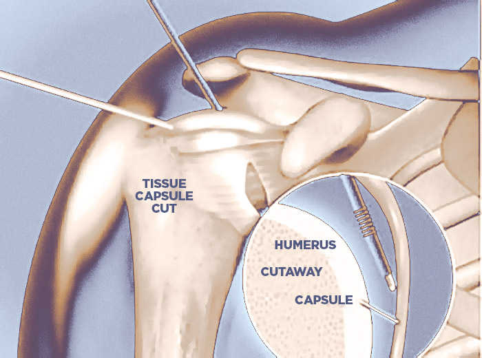 Ways to Treat a Frozen shoulder All About Bone Health and Joint Care