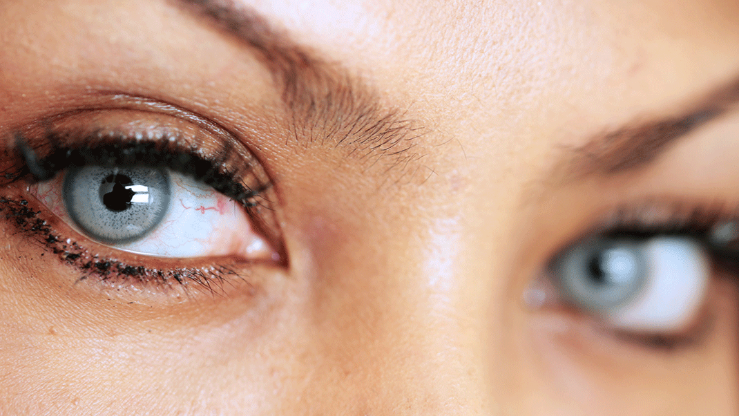 عمل تغییر رنگ چشم ، یک آرزوی محال یا واقعی؟ مجله سلامت دکترتو