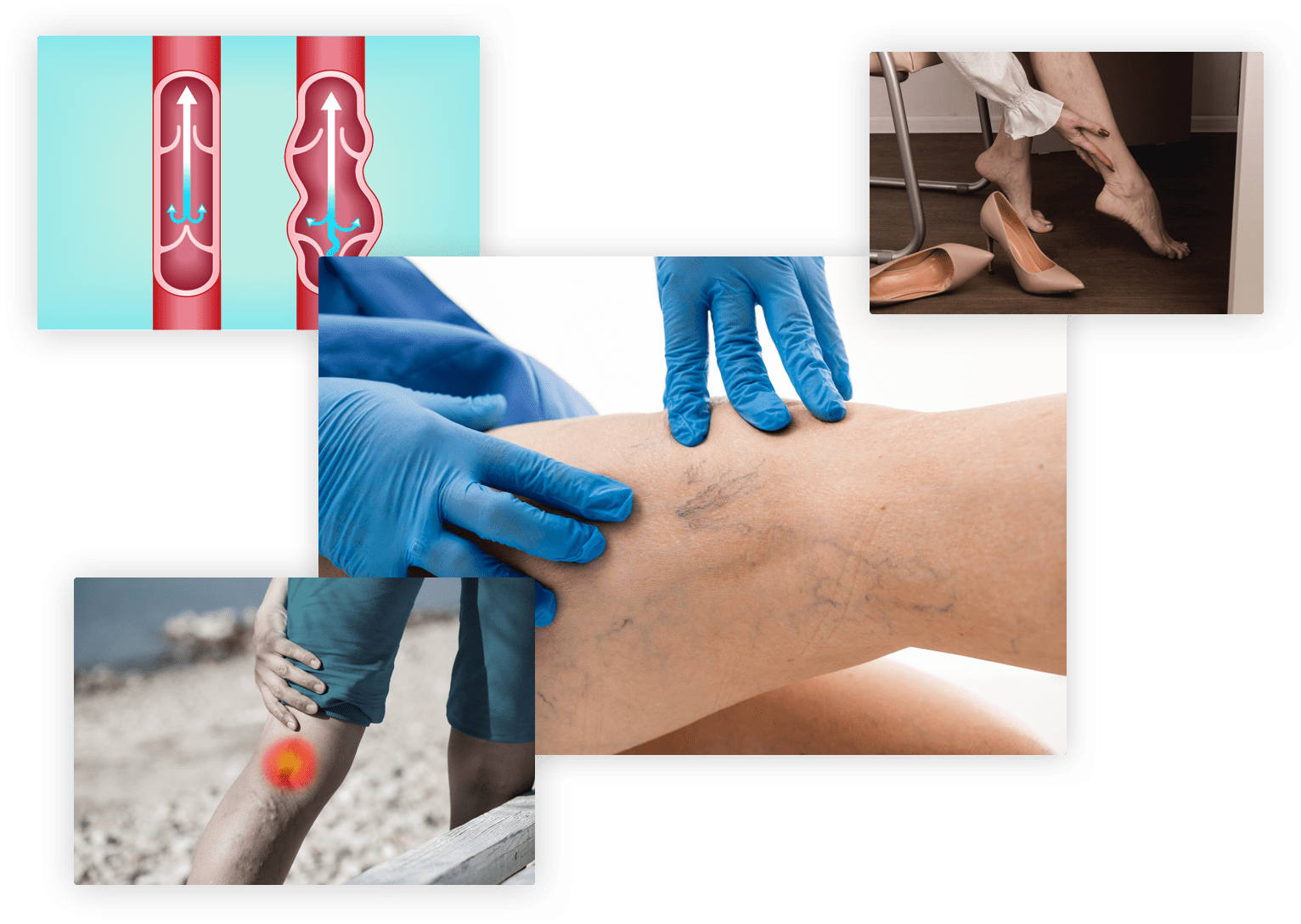 Qué son las varices Doctor Hernando