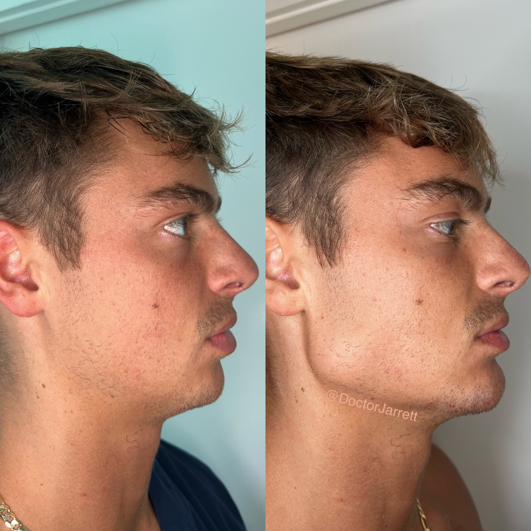 Chin & Jawline Contouring Designer Aesthetics by Dr. Jarrett Schanzer