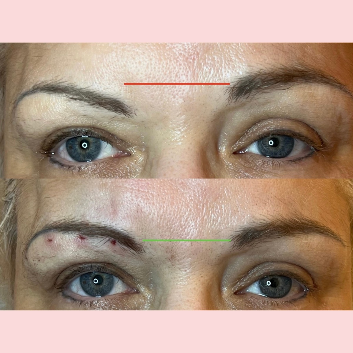 PDO Thread Lift Designer Aesthetics by Dr. Jarrett Schanzer Miami