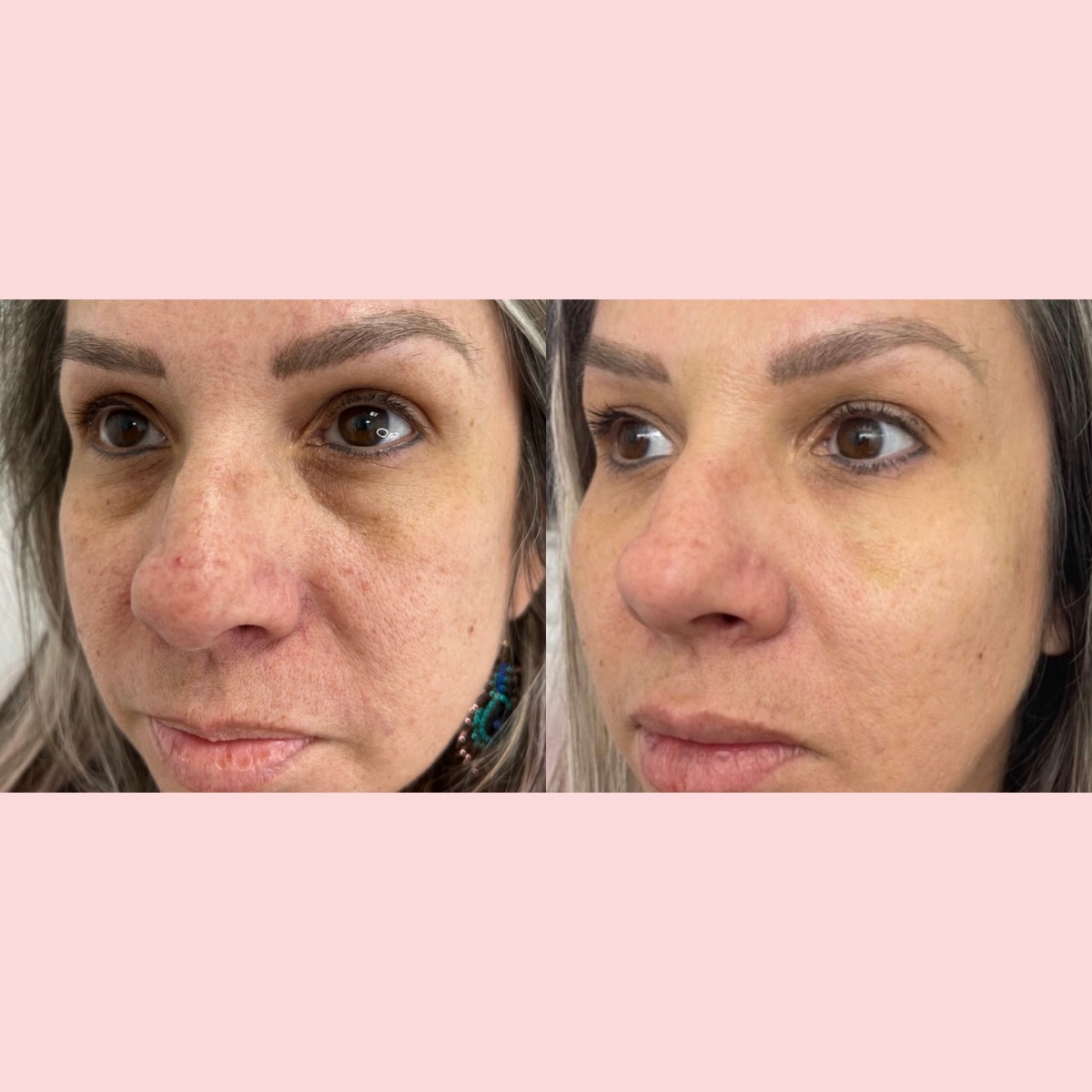 UnderEye Filler Designer Aesthetics by Dr. Jarrett Schanzer Miami