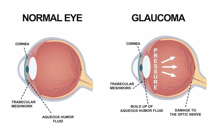 What is Glaucoma? Causes, Symptoms, Treatment | Dr Nathan Kerr