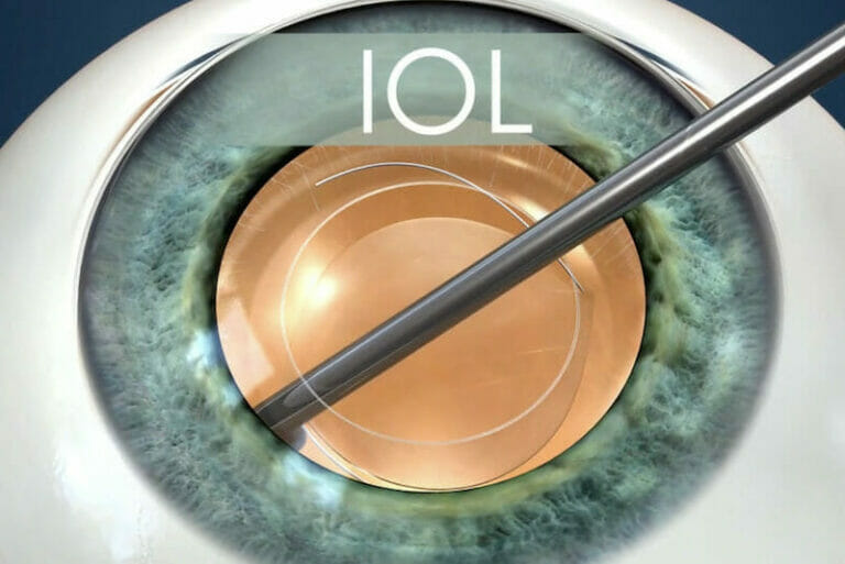 Intraocular lens choices for cataract surgery in people with