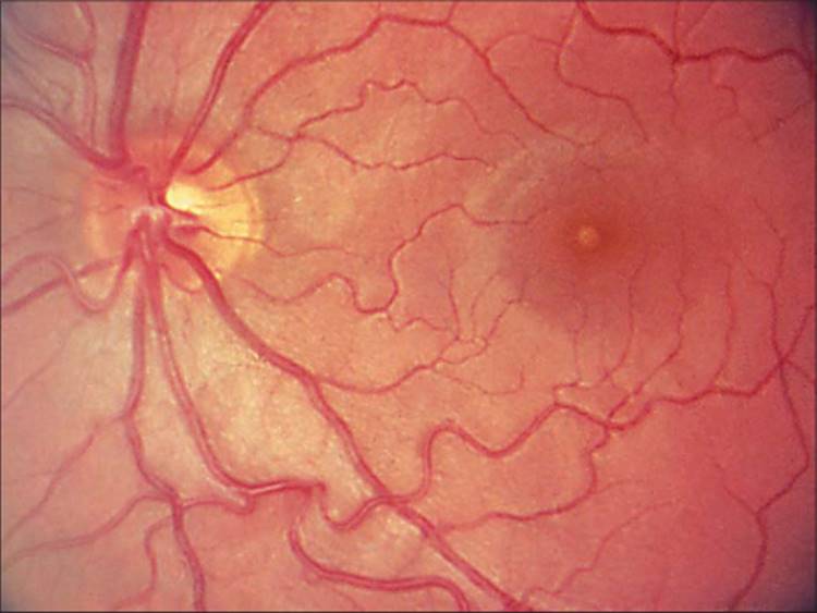 Photic Retinopathy RETINA AND VITREOUS Albert & Jakobiec's