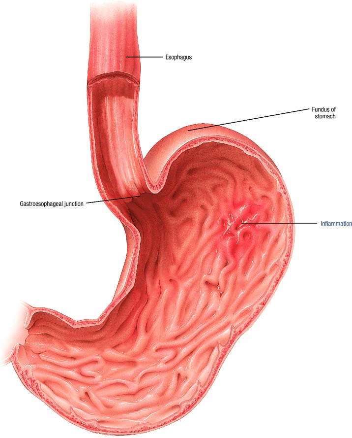 Gastritis Atlas of pathophysiology, 2 Edition
