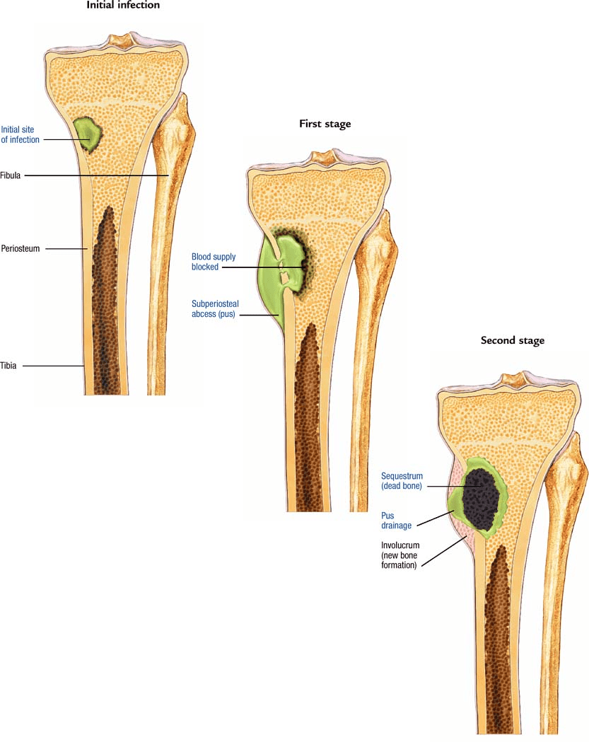 Osteomyelitis Atlas of pathophysiology, 2 Edition