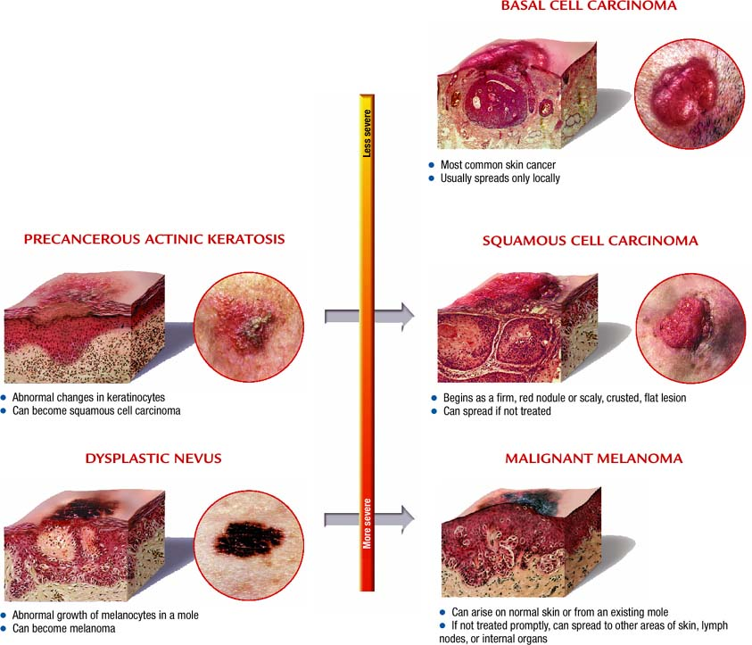 Skin cancers Atlas of pathophysiology, 2 Edition