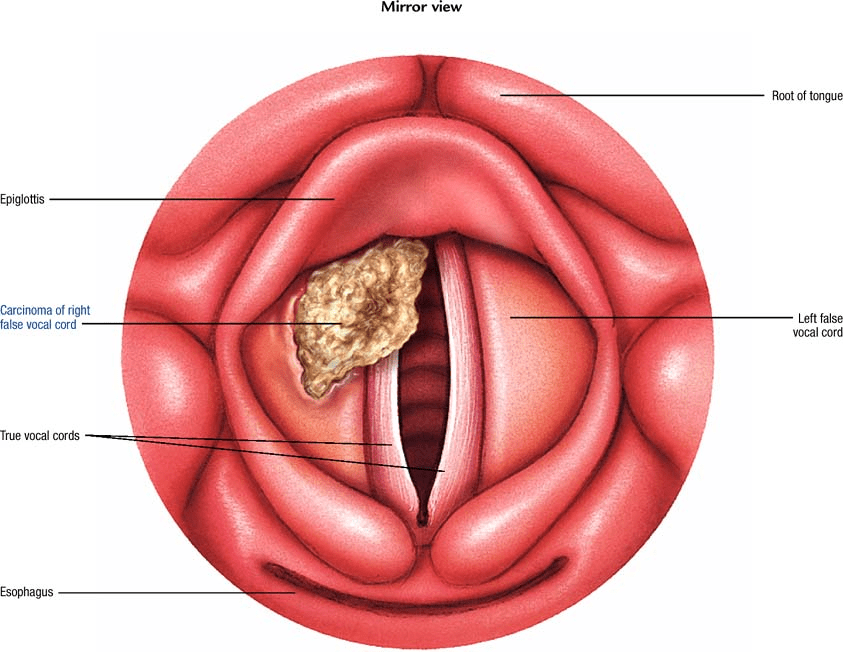 Laryngeal cancer Atlas of pathophysiology, 2 Edition