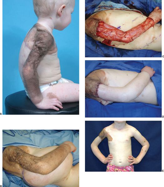 TISSUE EXPANSION Plastic surgery