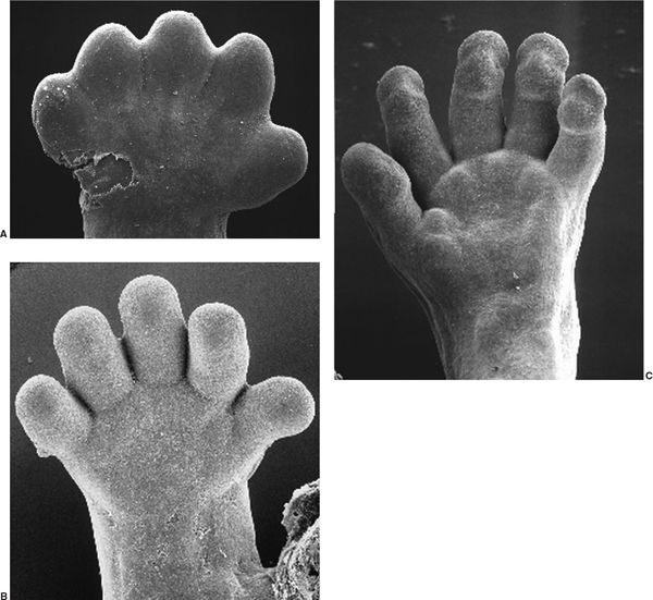 COMMON CONGENITAL HAND ANOMALIES Plastic surgery