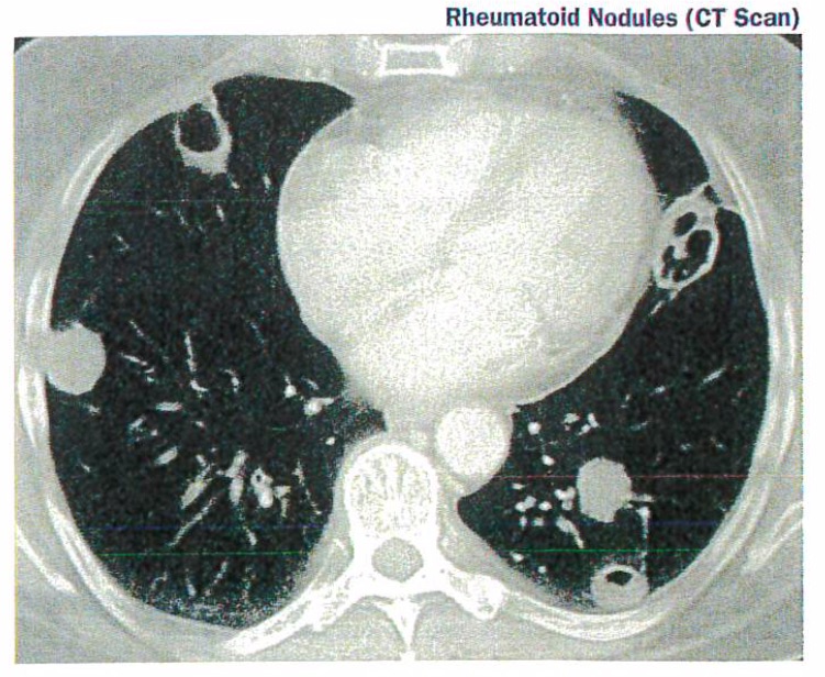Pulmonary Manifestations of Rheumatoid Arthritis Doctorpedia