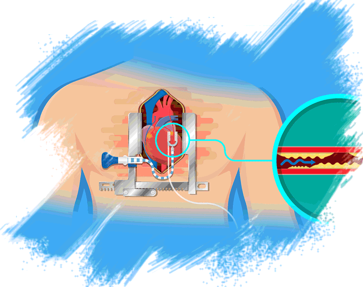 CABG Coronary Artery Bypass Grafting Surgery, Cost