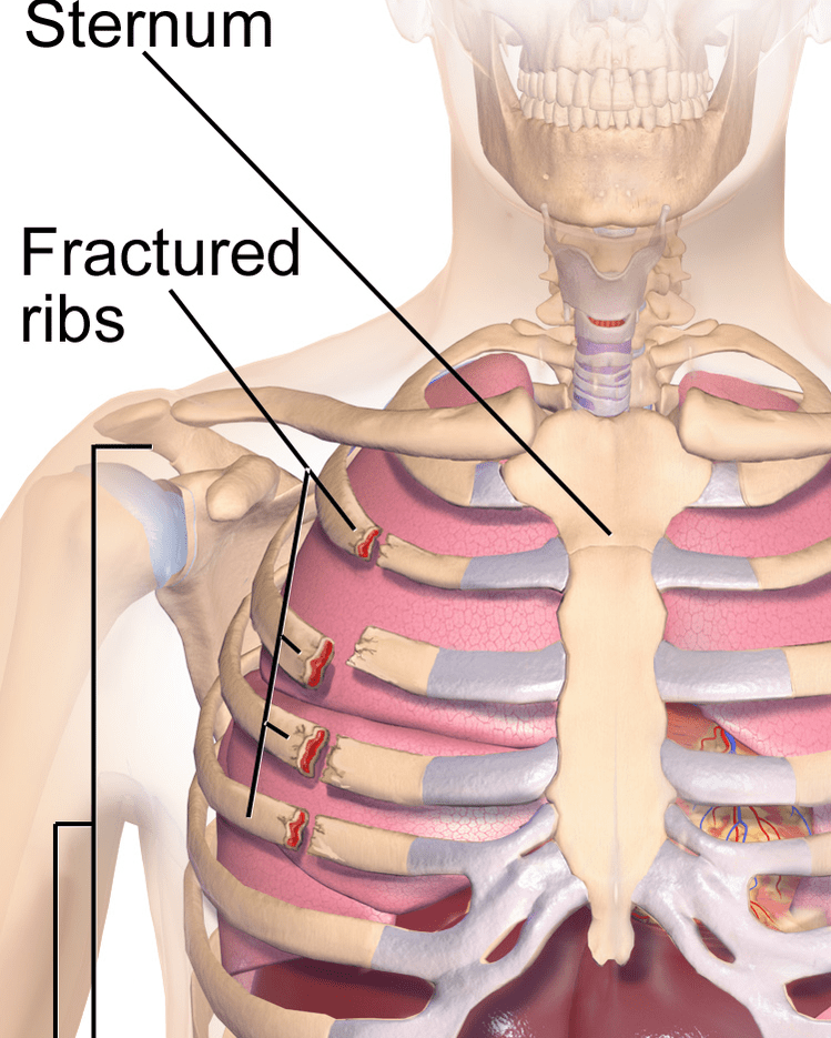 See Just How Common FasciaRelated Musculoskeletal Chest Pain and Rib