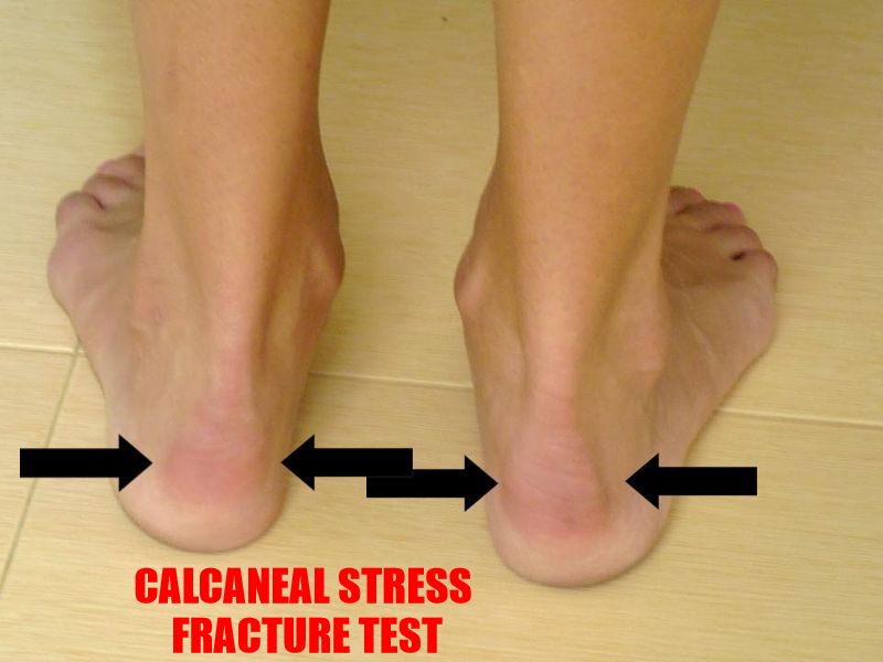 Got Kids? It's Important to Know the Difference Between Plantar Fasciitis and Calcaneal Stress
