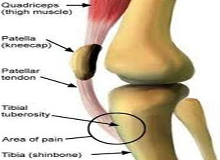 Osgood Schlatter's Syndrome DR. RUSSELL SCHIERLING