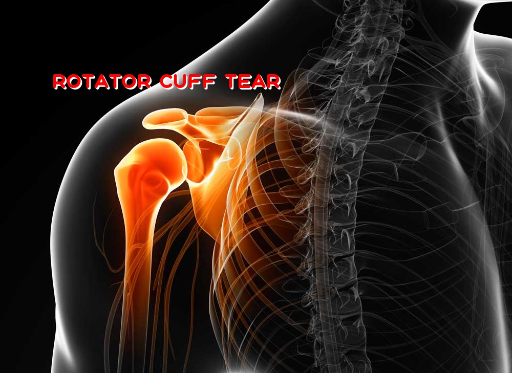 Medicine Mayo Clinic Research Speeds Rotator Cuff Tear Healing Period