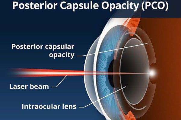 YAG Capsulotomy
