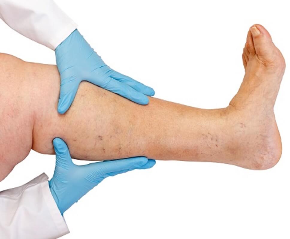 Cara Menghilangkan Varises pada Kaki Secara Alami