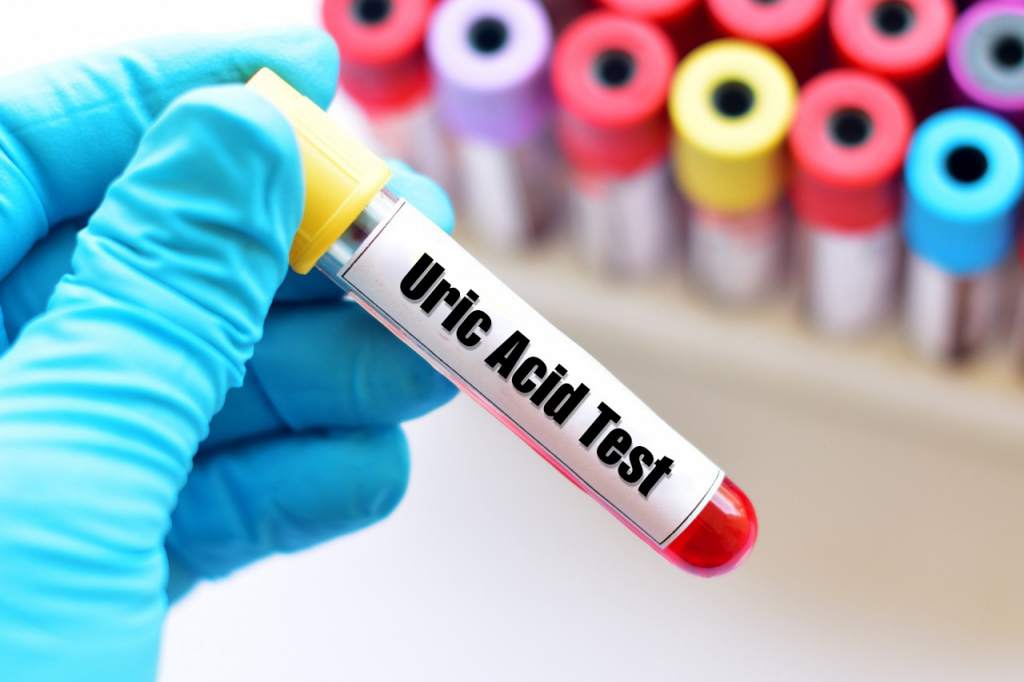 Uric Acid Nilai Normal & Nilai Tidak Normal Uric Acid Nilai Normal & Nilai Tidak Normal