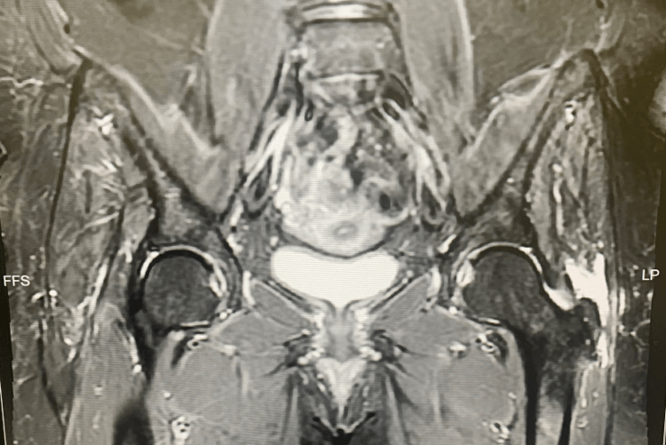 Gluteus Medius and Minimus Tears Frisco, TX Orthopedic Surgeon