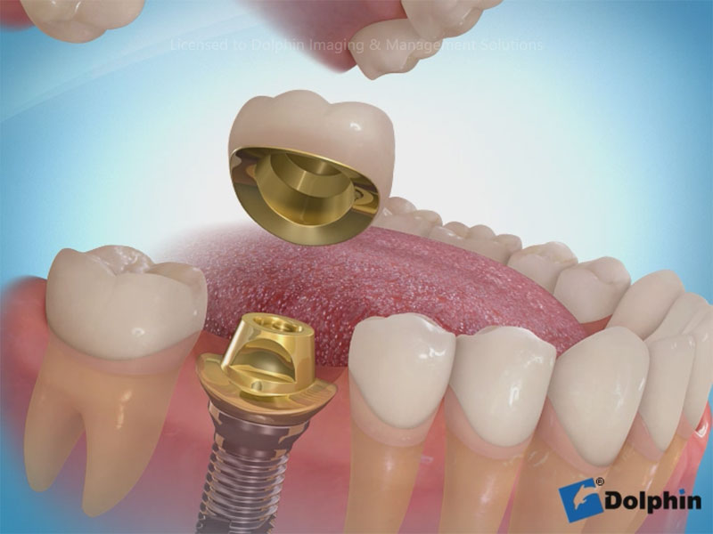 Dolphin Aquarium Surgery & Orthodontics Sample Video Infolab snc