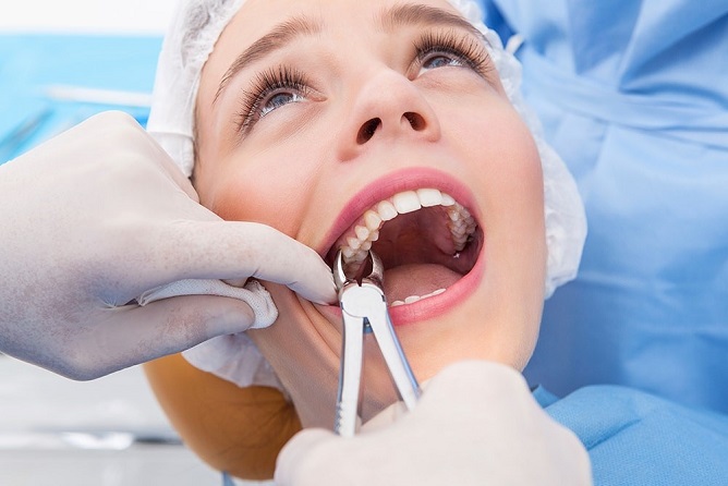 Combien de temps dure l'extraction des dents de sagesse Dolpxy